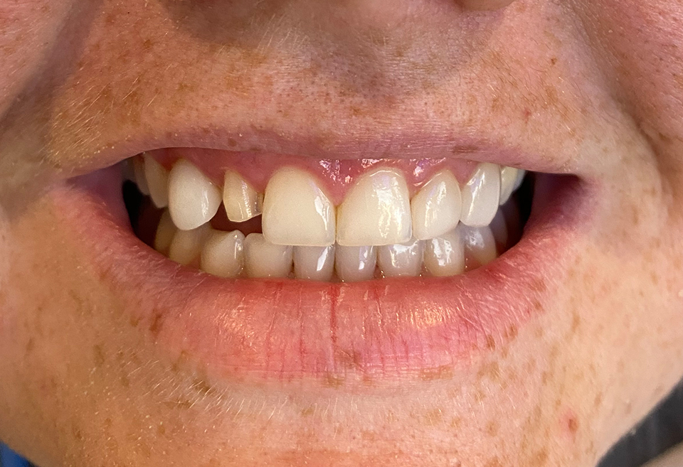 cc11